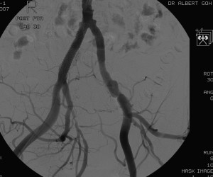 Post endovascular stent-graft repair of right common iliac aneurysm - Angiogram