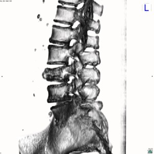 79yo lady with painful osteoporotic fracture of L3 vertebra