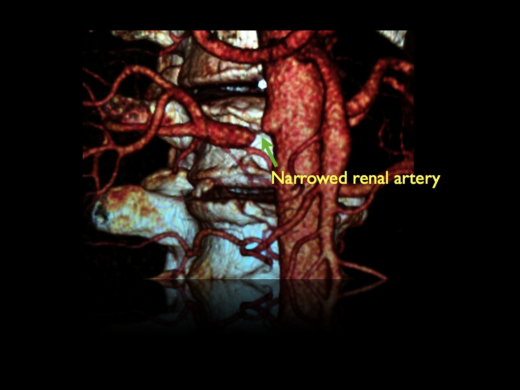 CT Angiogram demonstrates high grade narrowing (stenosis) in renal artery