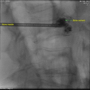 Bone needle inserted into vertebral body under high quality fluoroscopy