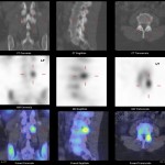 CT/ Bone scan fusion demonstrates increased activity in a left sided lumbar facet joint