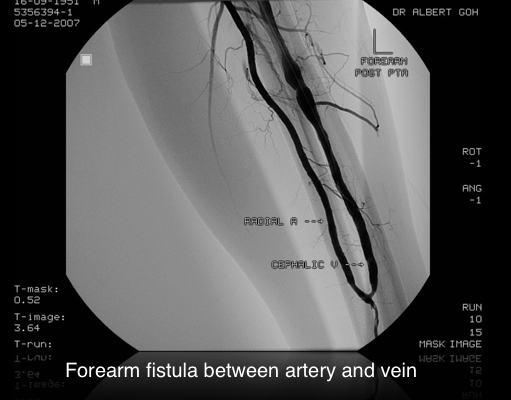 Forearm fistula between artery and vein