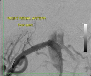 sydneymedicalinterventions, renal artery stent, interventional radiology