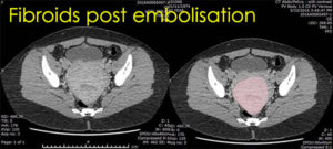 fibroids-post-embolisation